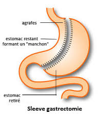 chirurgie obesite Tunisie - sleeve gastrectomie